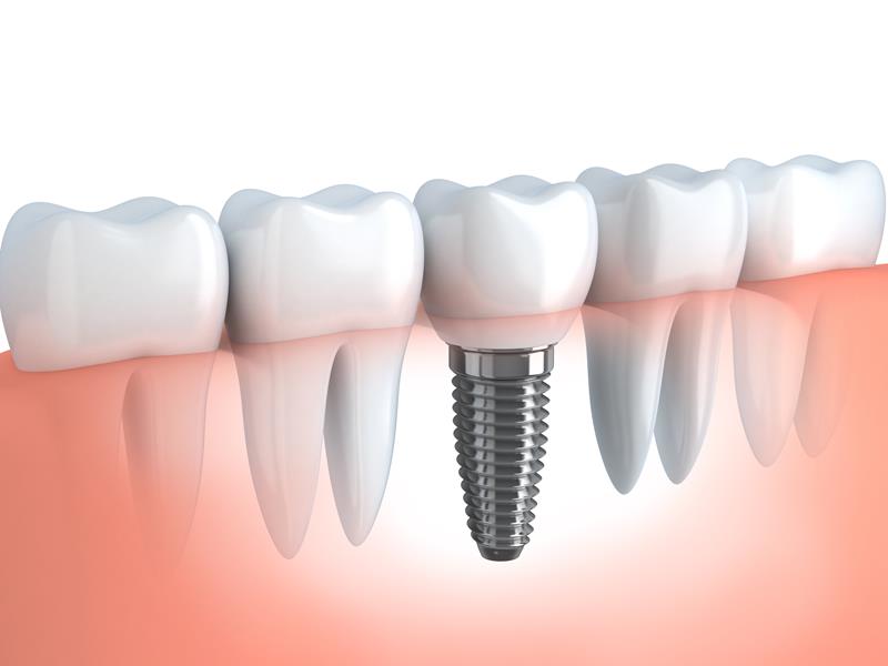 Dental implants in Manhattan NY