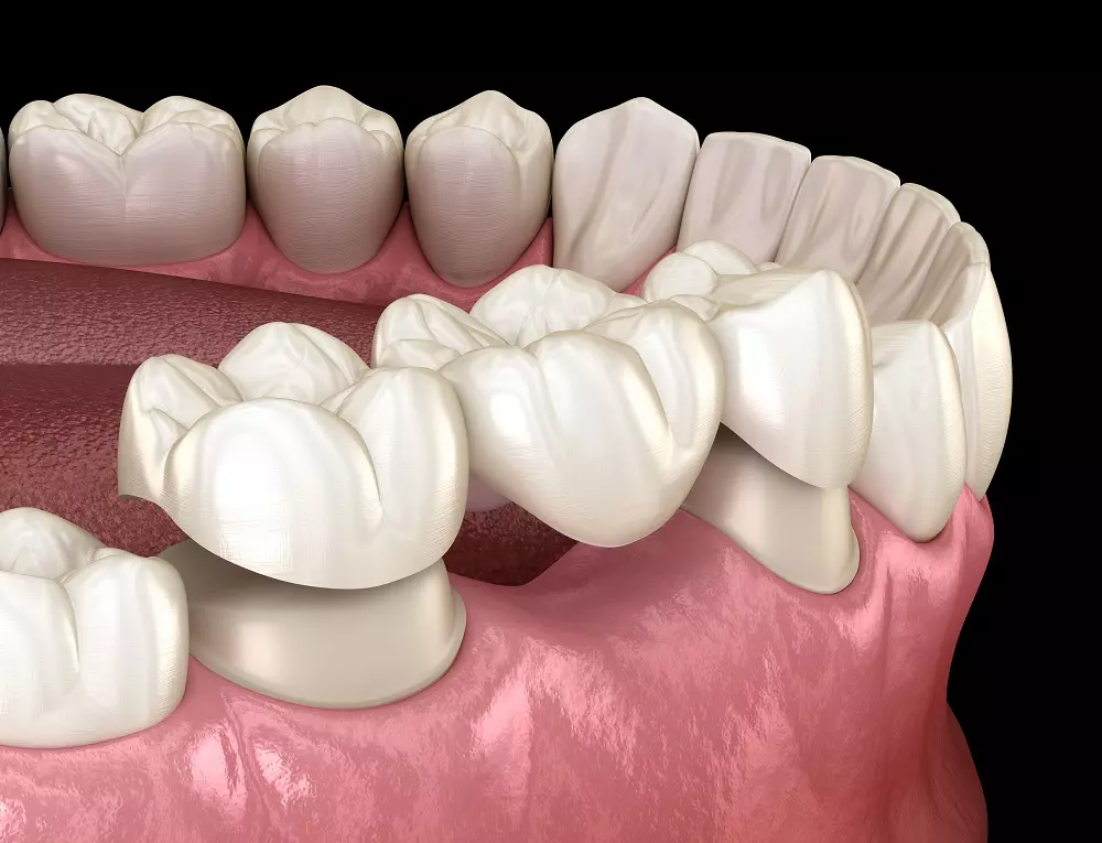 Dental bridges in Manhattan NY
